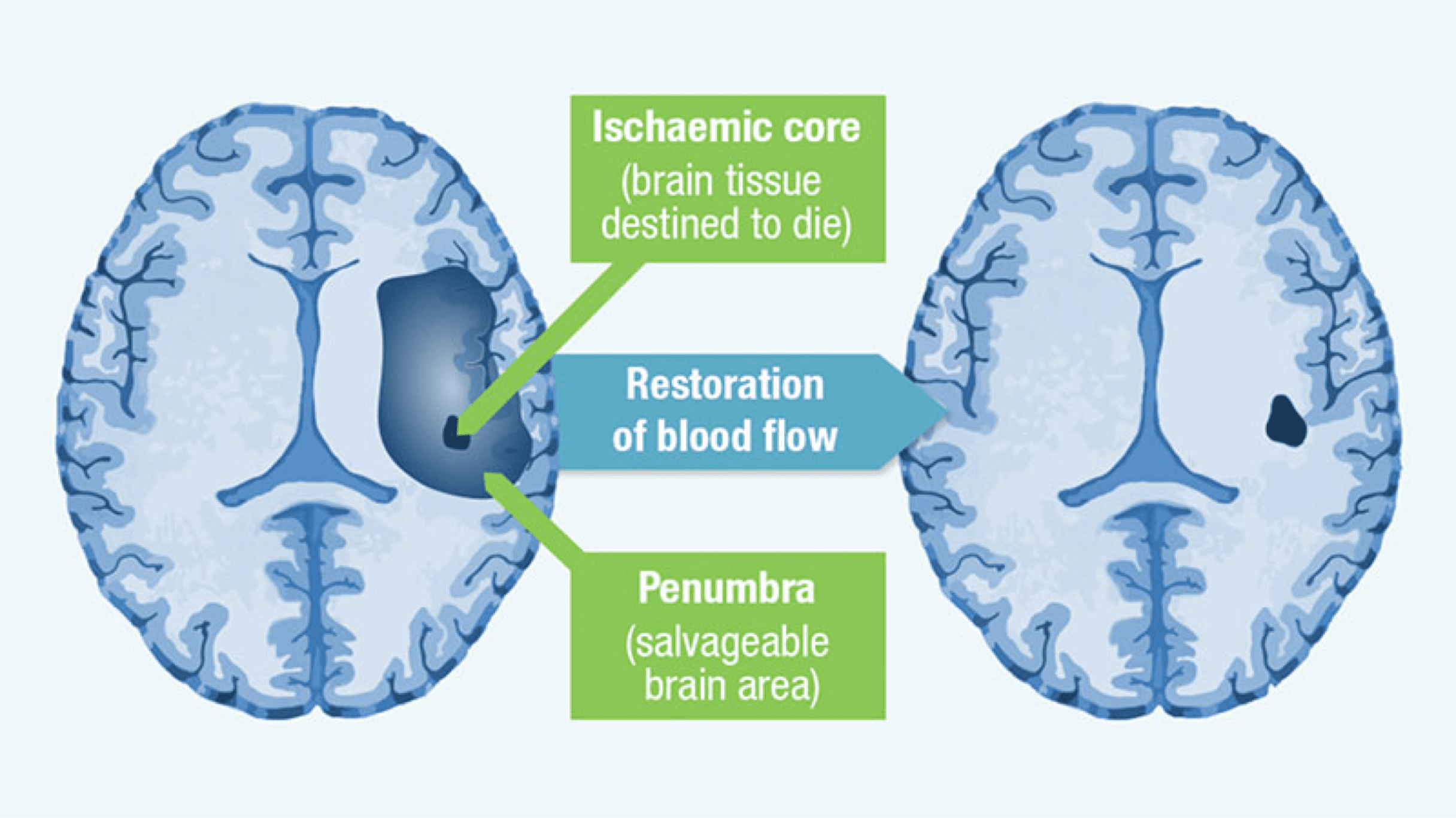 Pathophysiology Of Stroke Strokeforum 4255